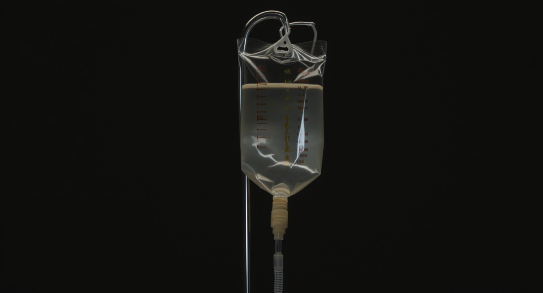 An IV drip bag hanging on a stand in a dark treatment room